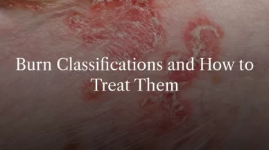 Burn Classification and How To Treat Them