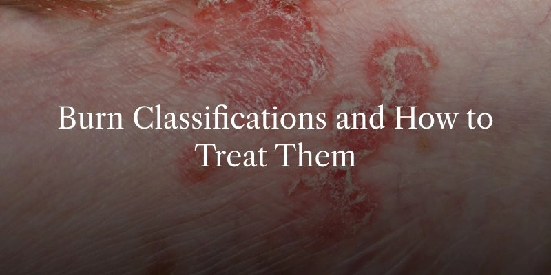 Burn Classification and How To Treat Them