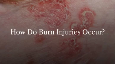 Common Causes of Burn Injuries